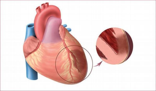 Протокол ведения пациентов с острым инфарктом миокарда