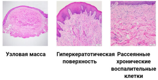 Фиброма кожи гистология фото у человека что это такое фото симптомы и лечение